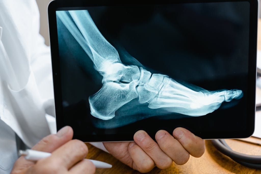 X-ray of foot - Hypothyroidism Affects Your Body